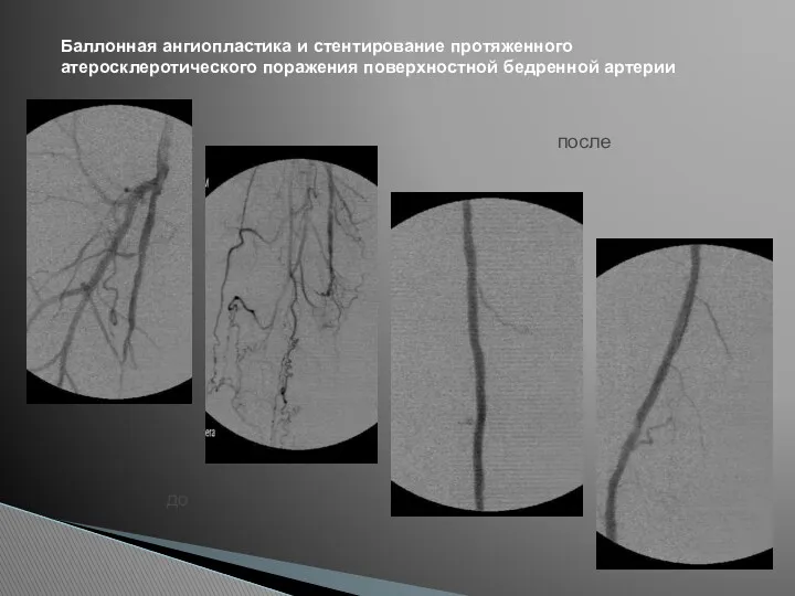 Баллонная ангиопластика и стентирование протяженного атеросклеротического поражения поверхностной бедренной артерии до после