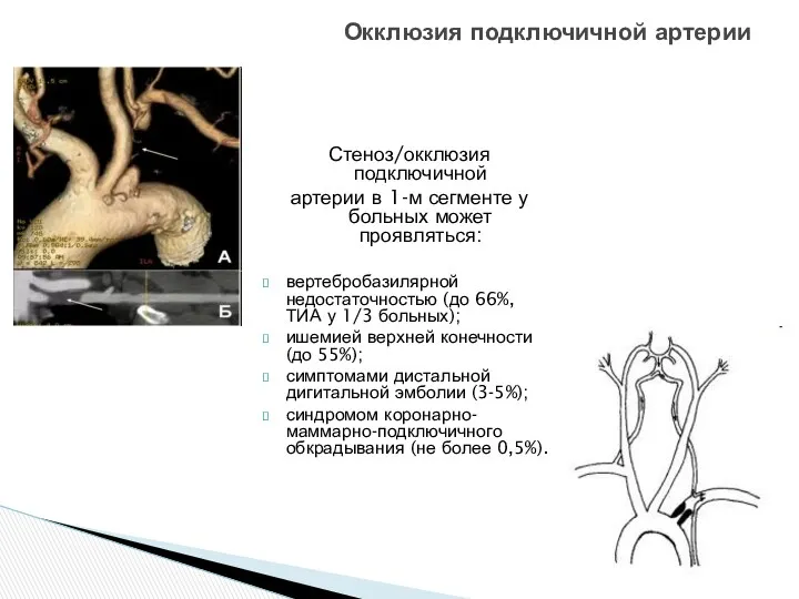 Окклюзия подключичной артерии Стеноз/окклюзия подключичной артерии в 1-м сегменте у