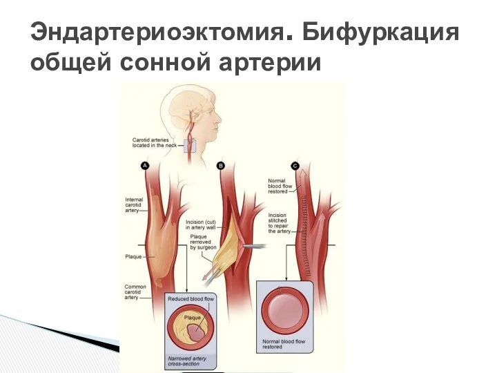 Эндартериоэктомия. Бифуркация общей сонной артерии