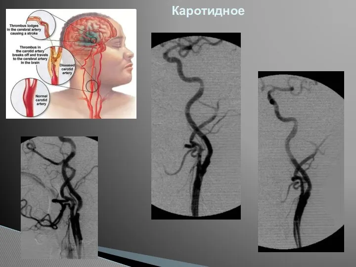 Каротидное стентирование