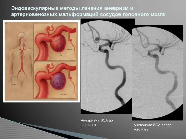 Эндоваскулярные методы лечения аневризм и артериовенозных мальформаций сосудов головного мозга