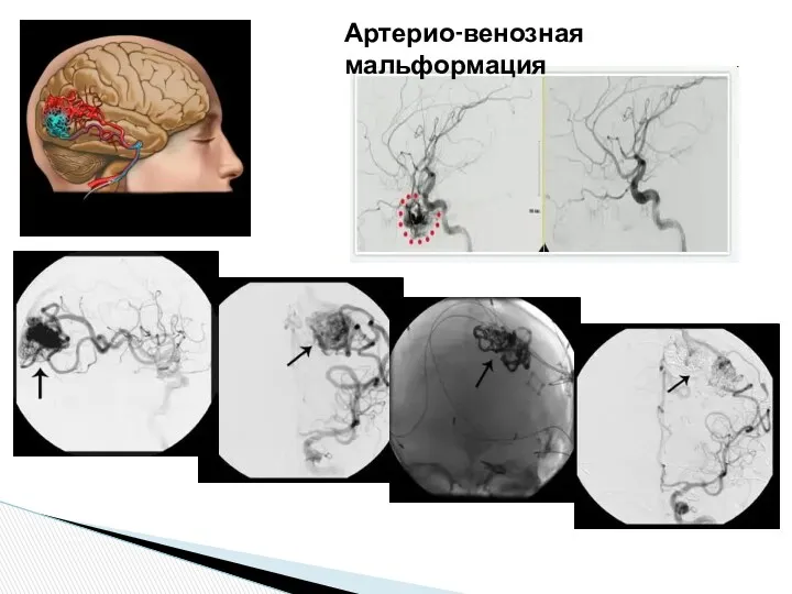 Артерио-венозная мальформация