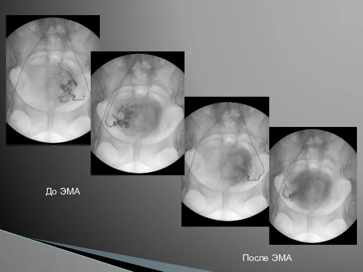 До ЭМА После ЭМА