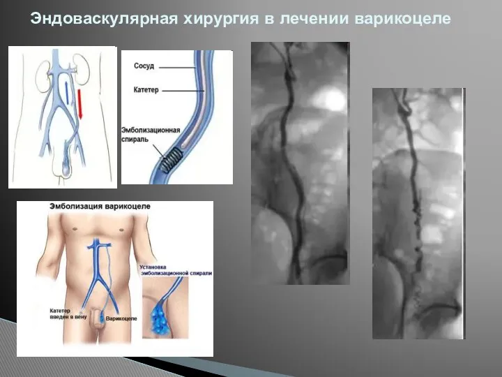 Эндоваскулярная хирургия в лечении варикоцеле