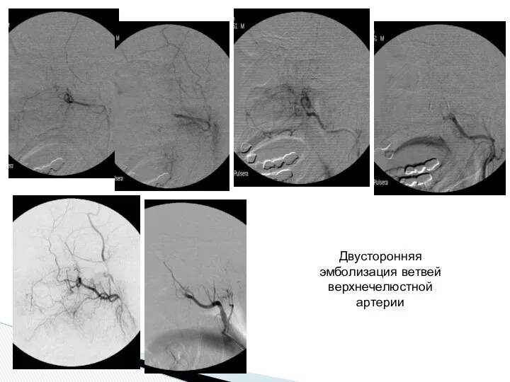 Двусторонняя эмболизация ветвей верхнечелюстной артерии