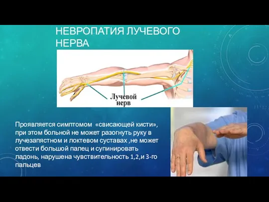 НЕВРОПАТИЯ ЛУЧЕВОГО НЕРВА Проявляется симптомом «свисающей кисти», при этом больной