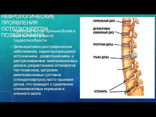 НЕВРОЛОГИЧЕСКИЕ ПРОЯВЛЕНИЯ ОСТЕОХОНДРОЗА ПОЗВОНОЧНИКА Наиболее частая причина болей в шее