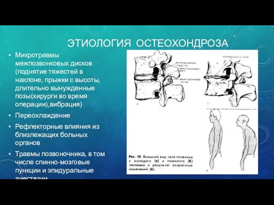 ЭТИОЛОГИЯ ОСТЕОХОНДРОЗА Микротравмы межпозвонковых дисков (поднятие тяжестей в наклоне, прыжки