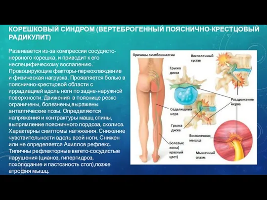 КОРЕШКОВЫЙ СИНДРОМ (ВЕРТЕБРОГЕННЫЙ ПОЯСНИЧНО-КРЕСТЦОВЫЙ РАДИКУЛИТ) Развивается из-за компрессии сосудисто-нервного корешка,