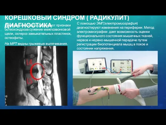 КОРЕШКОВЫЙ СИНДРОМ ( РАДИКУЛИТ) ДИАГНОСТИКА Рентгенологически различают признаки остеохондроза:сужение межпозвонковой