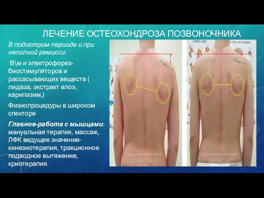 ЛЕЧЕНИЕ ОСТЕОХОНДРОЗА ПОЗВОНОЧНИКА В подостром периоде и при неполной ремисси: