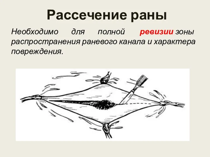 Рассечение раны Необходимо для полной ревизии зоны распространения раневого канала и характера повреждения.