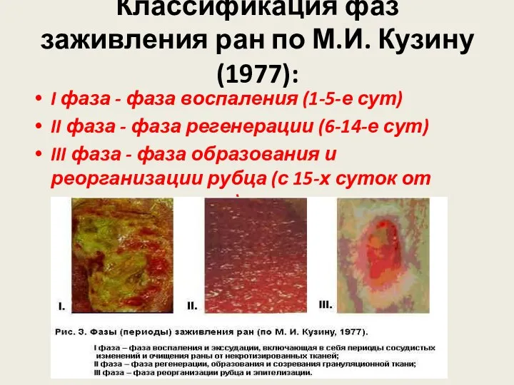 Классификация фаз заживления ран по М.И. Кузину (1977): I фаза