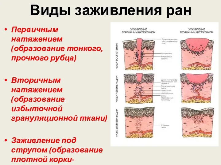 Виды заживления ран Первичным натяжением (образование тонкого, прочного рубца) Вторичным