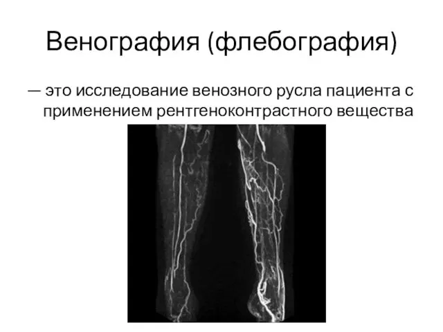 Венография (флебография) — это исследование венозного русла пациента с применением рентгеноконтрастного вещества