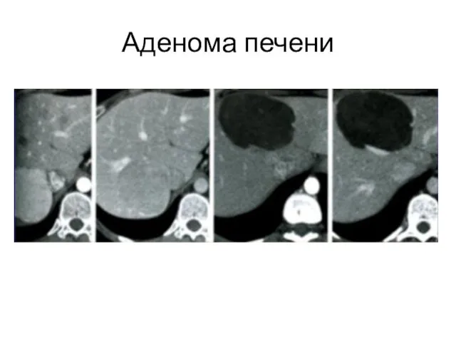 Аденома печени