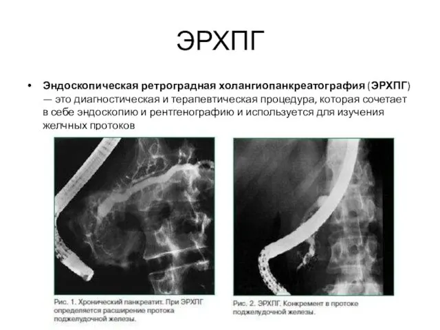 ЭРХПГ Эндоскопическая ретроградная холангиопанкреатография (ЭРХПГ) — это диагностическая и терапевтическая процедура, которая сочетает