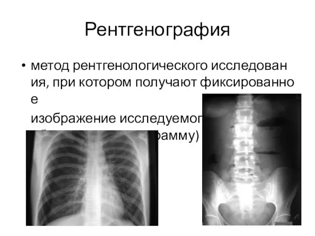 Рентгенография метод рентгенологического исследования, при котором получают фиксированное изображение исследуемого объекта (рентгенограмму)