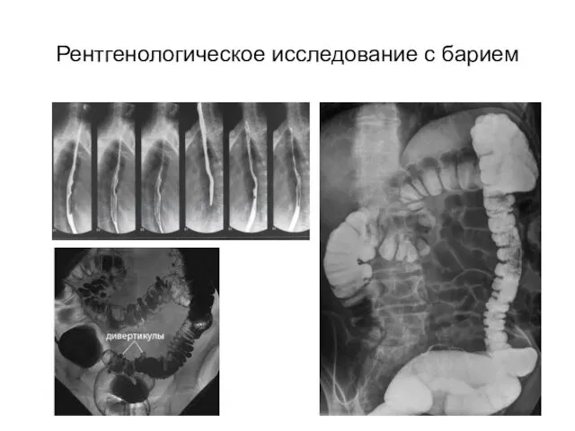 Рентгенологическое исследование с барием