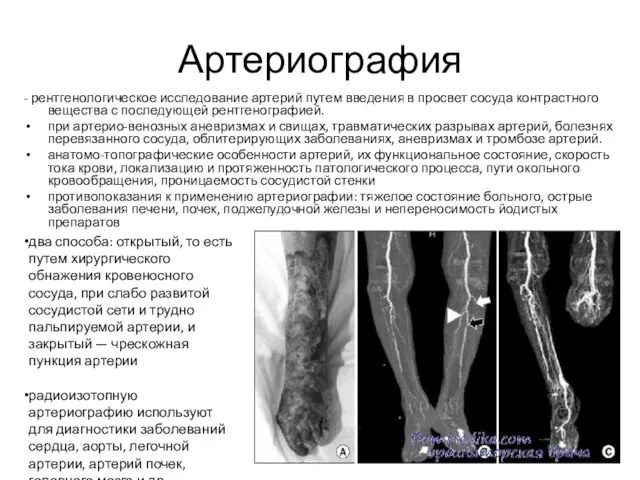 Артериография - рентгенологическое исследование артерий путем введения в просвет сосуда контрастного вещества с