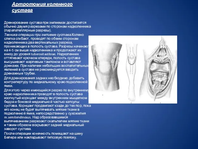 Артротомия коленного сустава Дренирование сустава при эмпиемах достигается обычно двумя