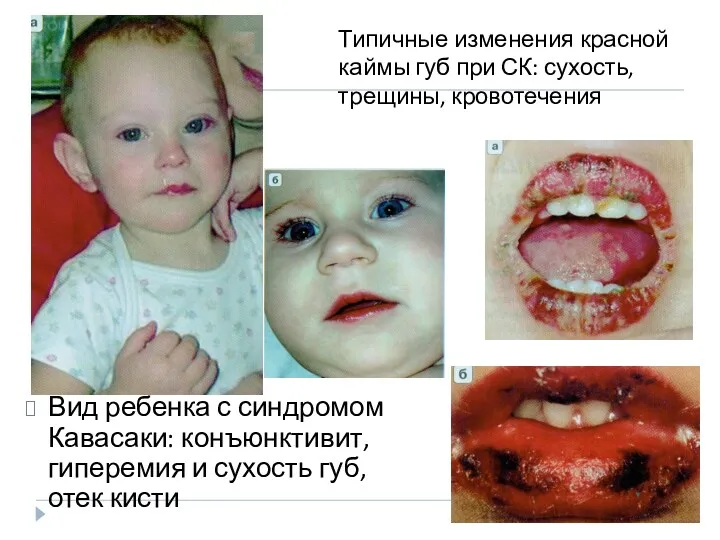 Вид ребенка с синдромом Кавасаки: конъюнктивит, гиперемия и сухость губ, отек кисти Типичные