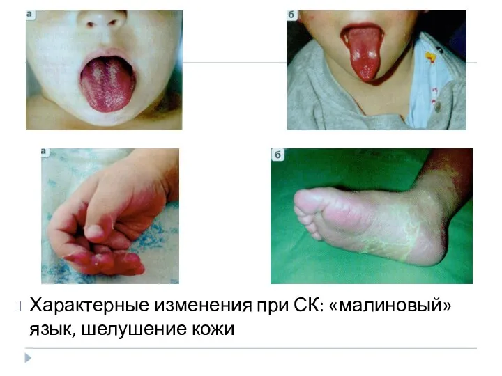 Характерные изменения при СК: «малиновый» язык, шелушение кожи