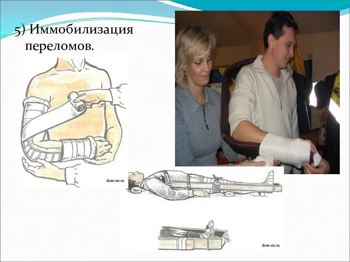 5) Иммобилизация переломов.