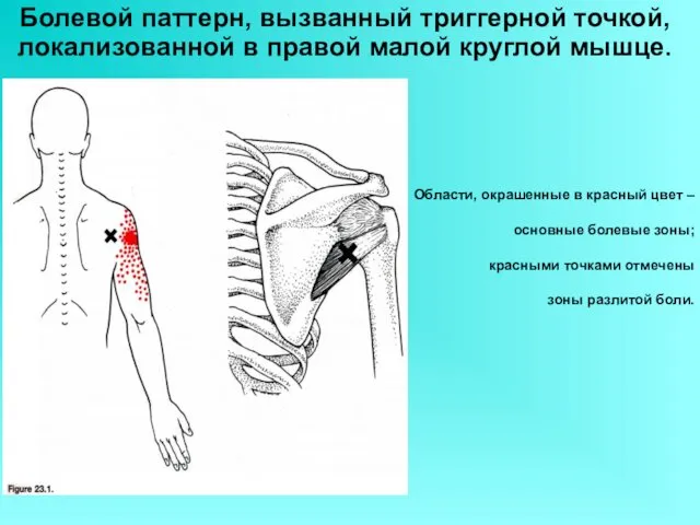 Болевой паттерн, вызванный триггерной точкой, локализованной в правой малой круглой мышце. Области, окрашенные