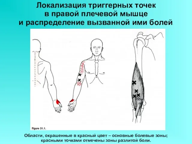 Локализация триггерных точек в правой плечевой мышце и распределение вызванной ими болей. Области,