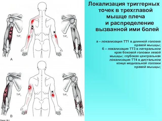 Локализация триггерных точек в трехглавой мышце плеча и распределение вызванной ими болей а
