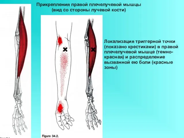 Прикрепления правой плечелучевой мышцы (вид со стороны лучевой кости) Локализация триггерной точки (показано
