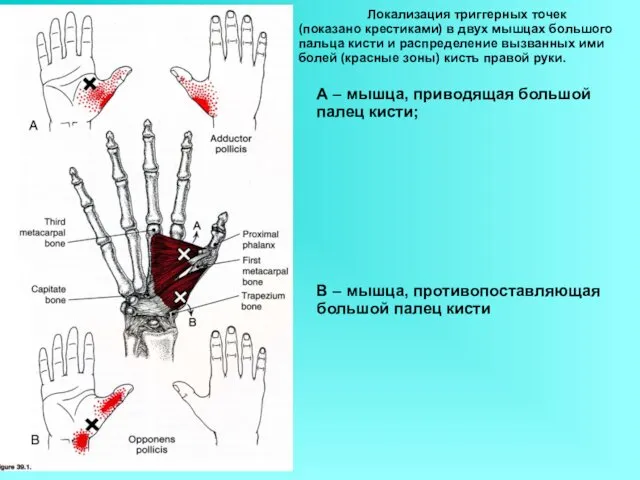 А – мышца, приводящая большой палец кисти; В – мышца, противопоставляющая большой палец