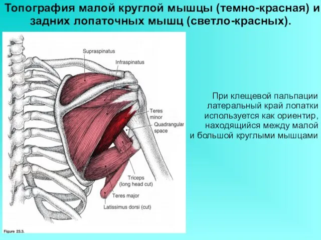 Топография малой круглой мышцы (темно-красная) и задних лопаточных мышц (светло-красных). При клещевой пальпации