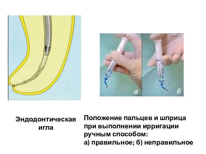 Эндодонтическая игла Положение пальцев и шприца при выполнении ирригации ручным способом: а) правильное; б) неправильное