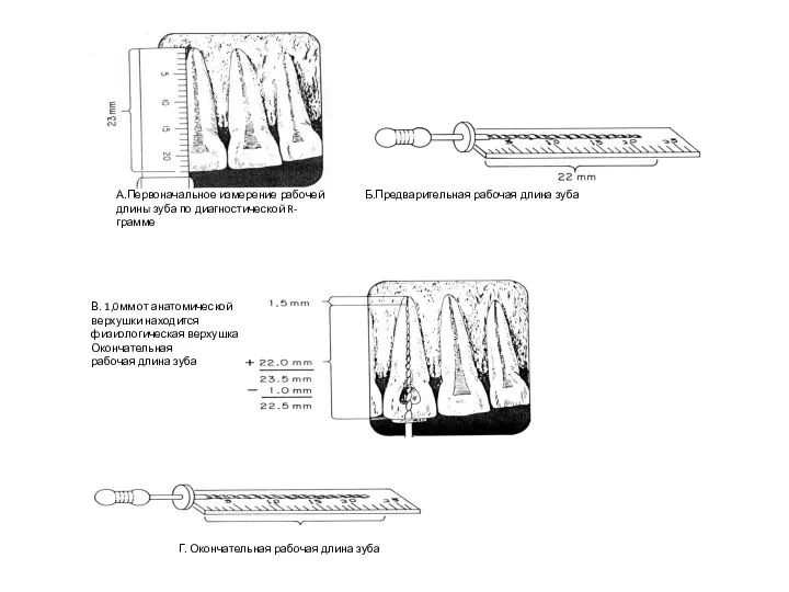 А.Первоначальное измерение рабочей длины зуба по диагностической R-грамме Б.Предварительная рабочая