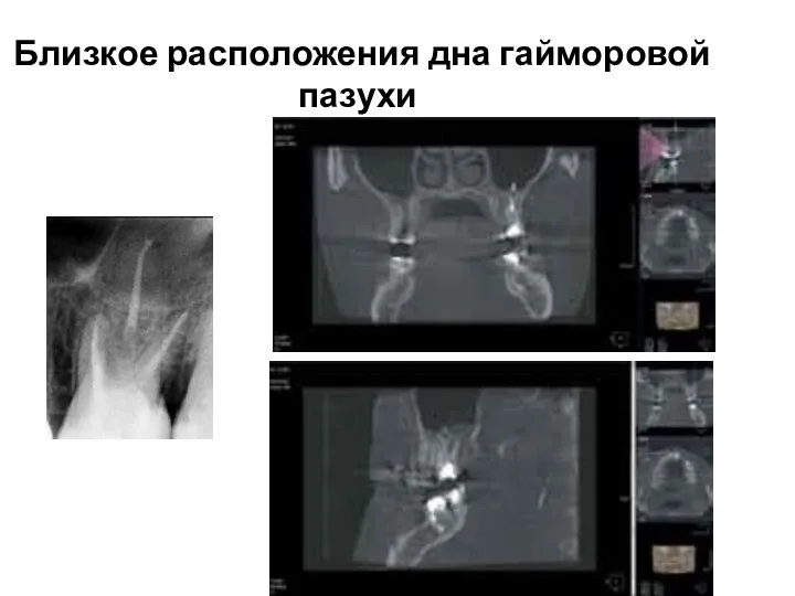 Близкое расположения дна гайморовой пазухи