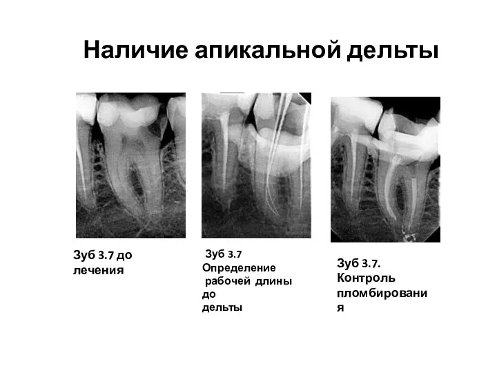 Наличие апикальной дельты Зуб 3.7 до лечения Зуб 3.7 Определение