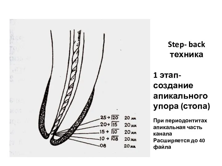 Step- back техника 1 этап- создание апикального упора (стопа) При