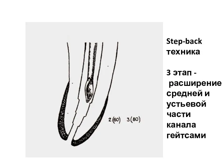 Step-back техника 3 этап - расширение средней и устьевой части канала гейтсами