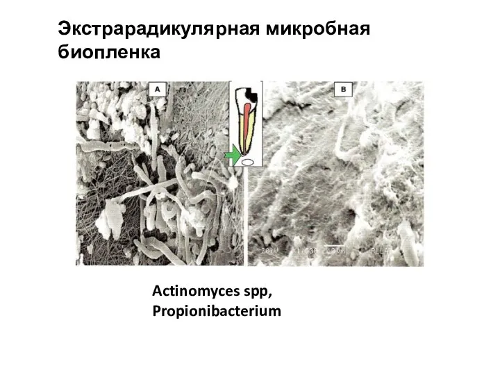 Экстрарадикулярная микробная биопленка Actinomyces spp, Propionibacterium