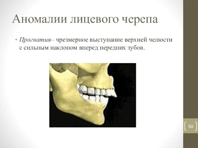 Аномалии лицевого черепа Прогнатия– чрезмерное выступание верхней челюсти с сильным наклоном вперед передних зубов.