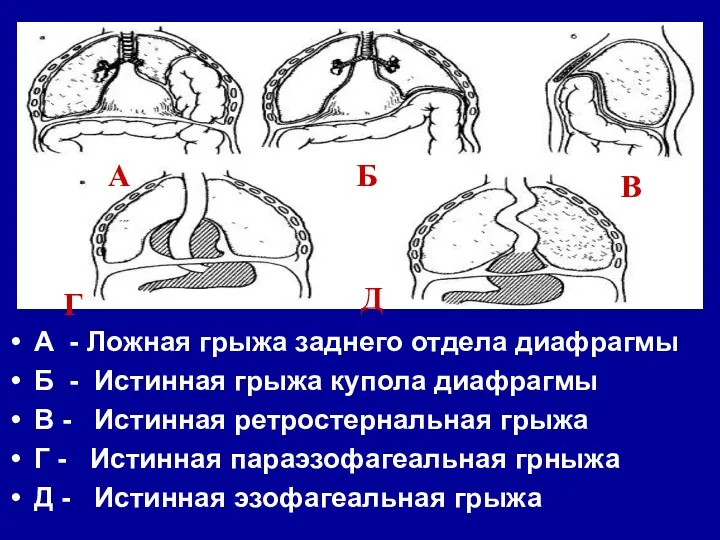 А - Ложная грыжа заднего отдела диафрагмы Б - Истинная