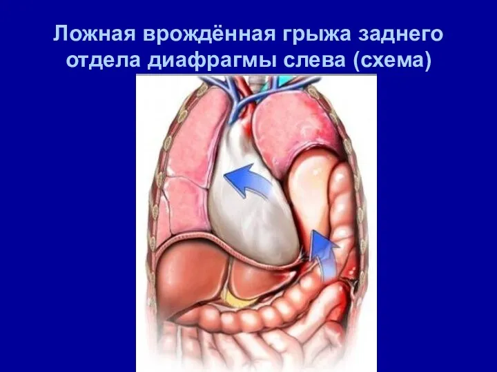 Ложная врождённая грыжа заднего отдела диафрагмы слева (схема)