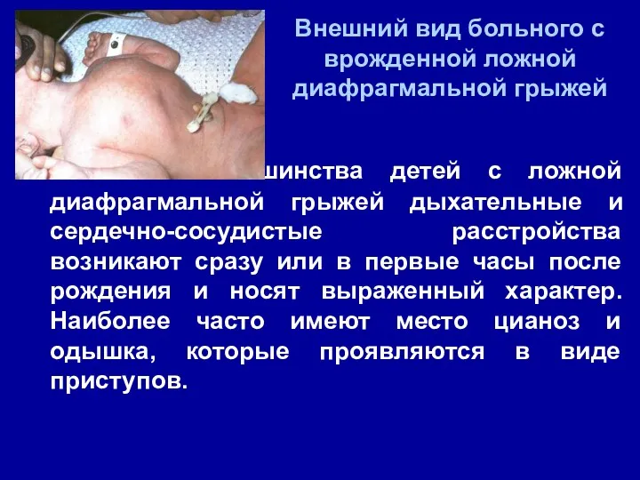 У большинства детей с ложной диафрагмальной грыжей дыхательные и сердечно-сосудистые