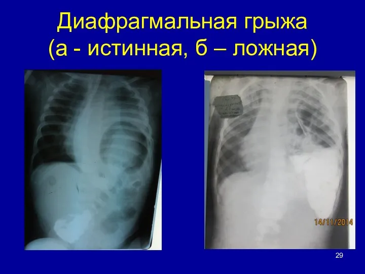 Диафрагмальная грыжа (а - истинная, б – ложная) а б