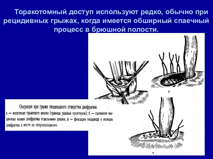 Торакотомный доступ используют редко, обычно при рецидивных грыжах, когда имеется обширный спаечный процесс в брюшной полости.