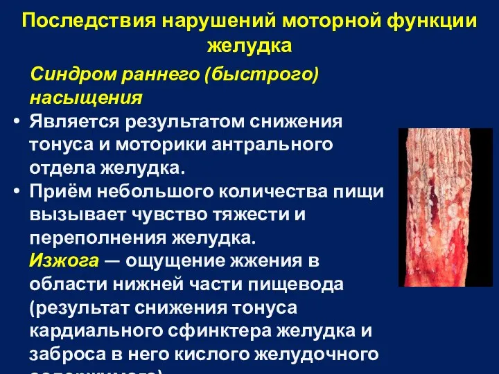 Последствия нарушений моторной функции желудка Синдром раннего (быстрого) насыщения Является