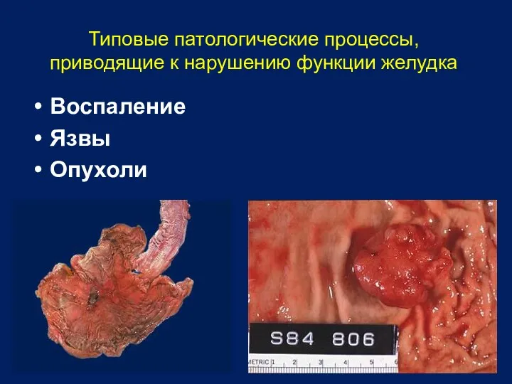 Воспаление Язвы Опухоли Типовые патологические процессы, приводящие к нарушению функции желудка