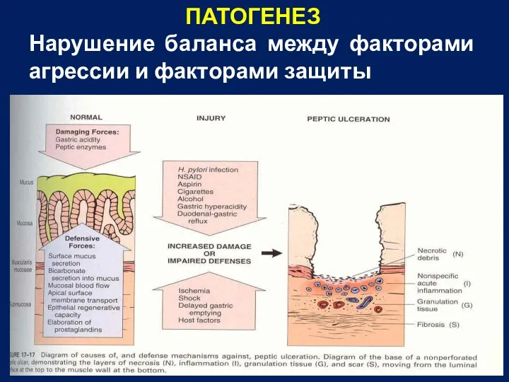 ПАТОГЕНЕЗ Нарушение баланса между факторами агрессии и факторами защиты